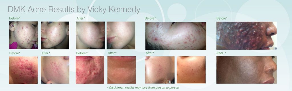 DMK acne results by Vicky Kennedy